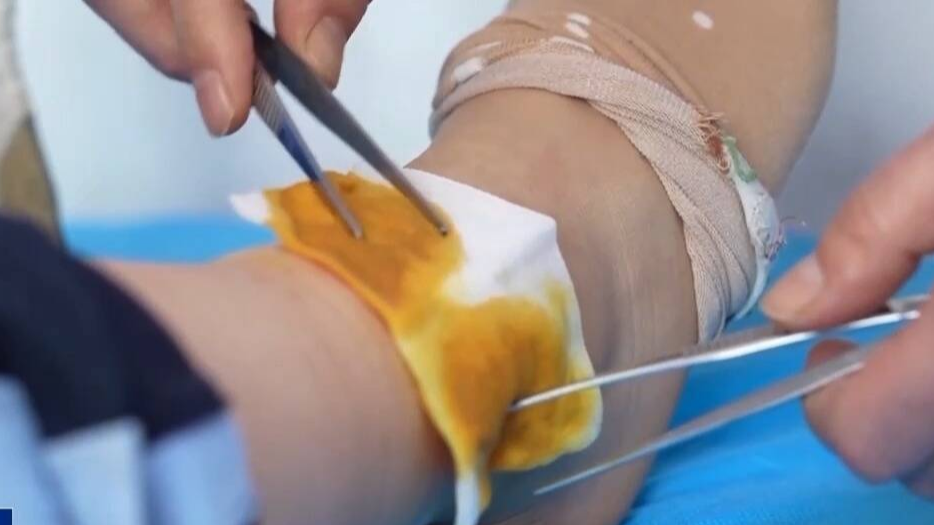 熱水袋竟會(huì)造成三級(jí)燙傷？冬季警惕&ldquo;溫暖殺手&rdquo;