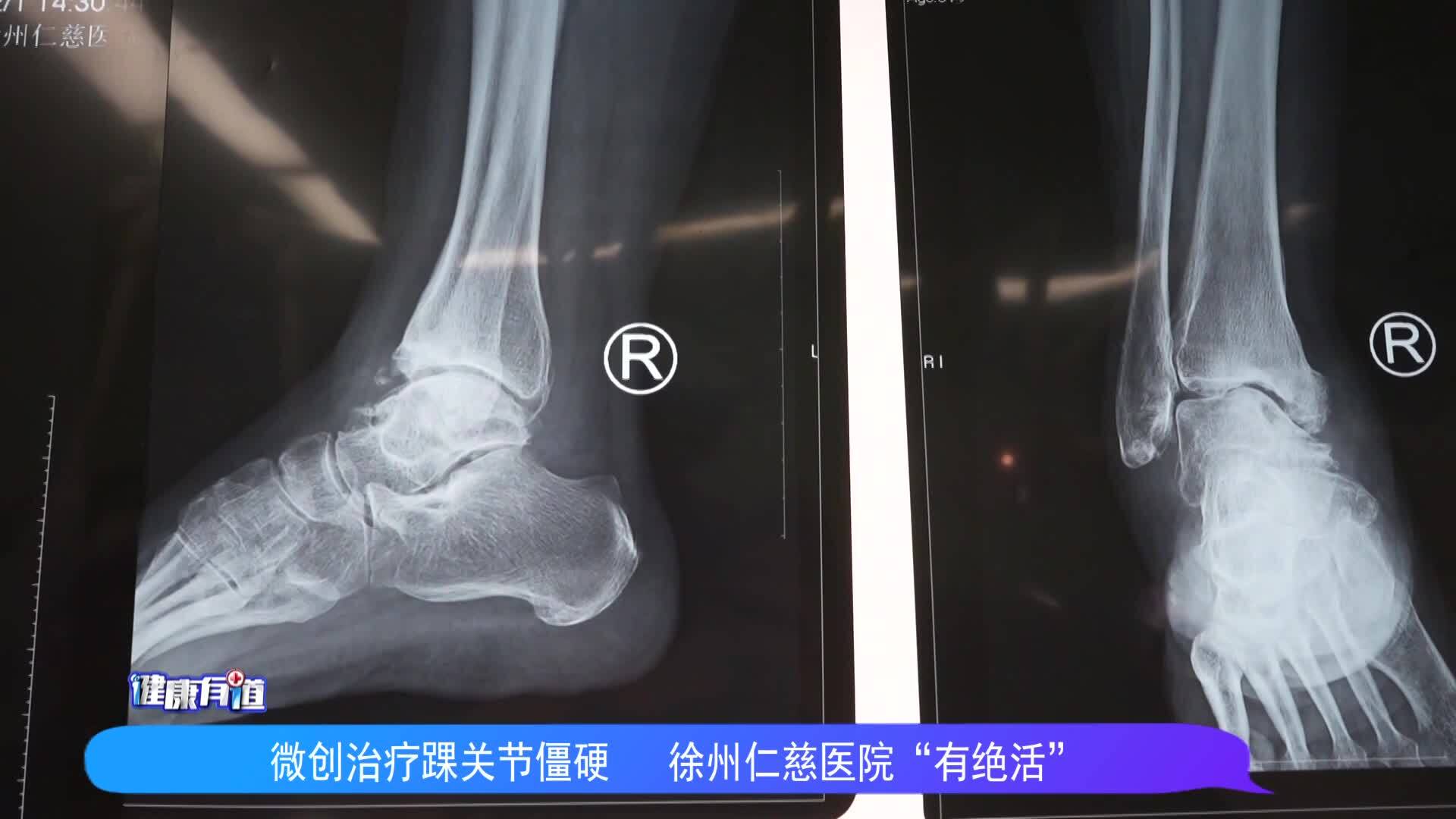 徐州仁慈醫(yī)院：微創(chuàng)治療踝關(guān)節(jié)僵硬 徐州仁慈醫(yī)院&ldquo;有絕活&rdquo;