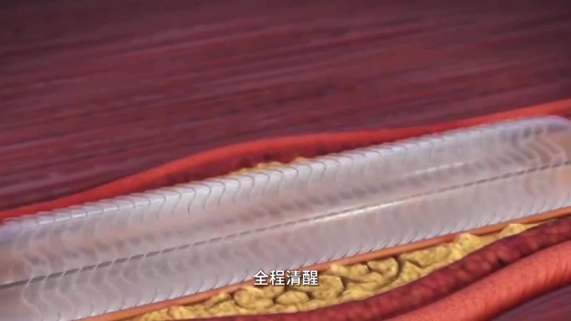 護理課堂：介入手術更需要精細護理！