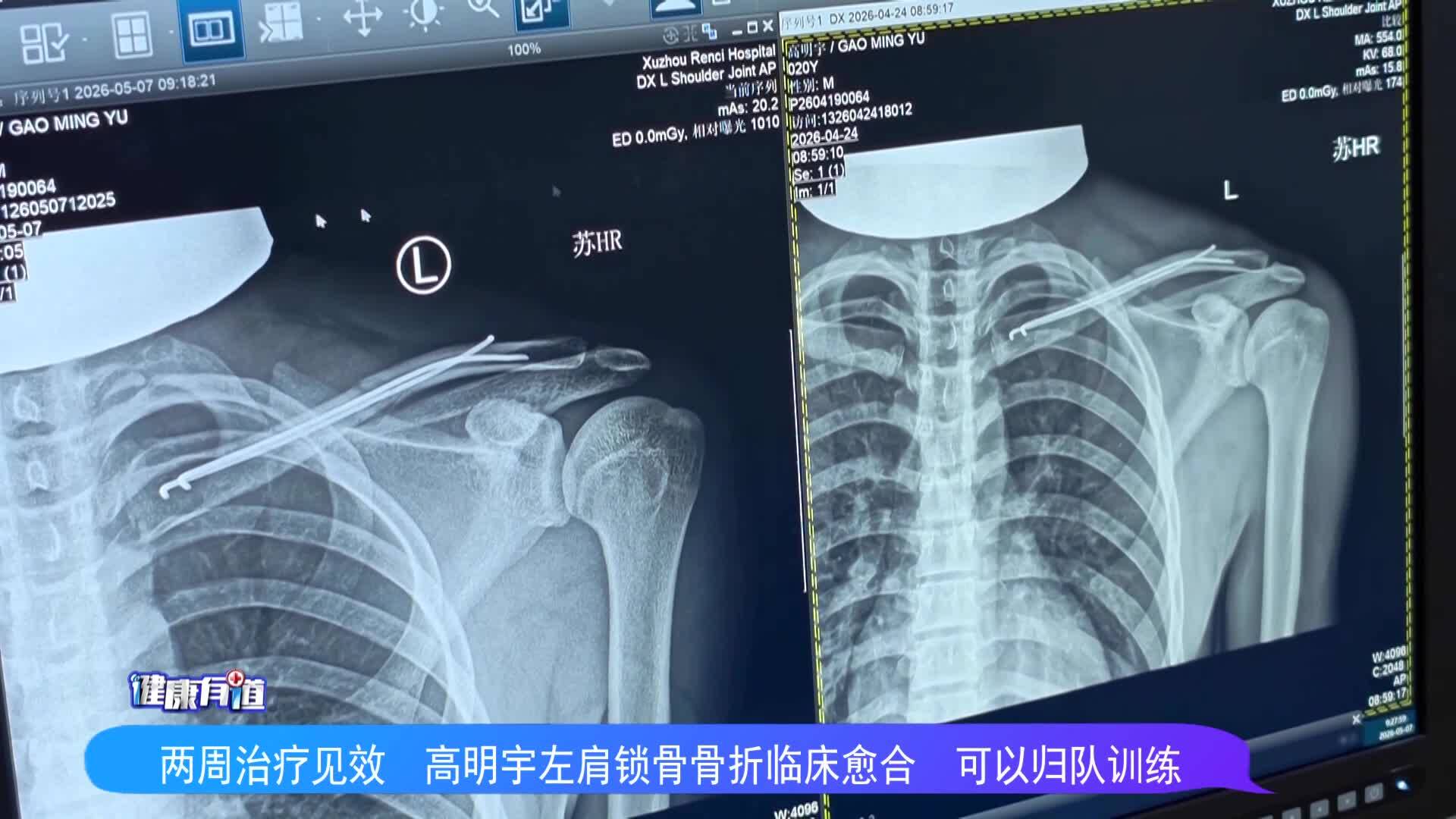 徐州仁慈醫院：兩周治療見效 高明宇左肩鎖骨骨折臨床愈合 可以歸隊訓練