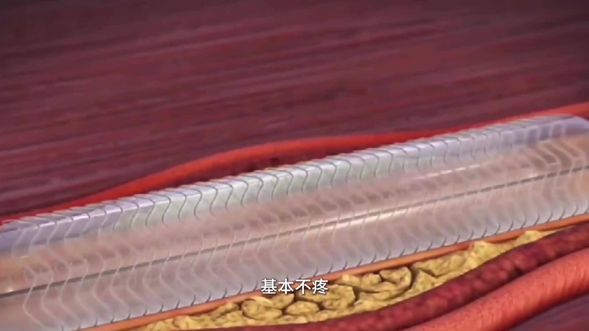 護理課堂：解決心臟的&ldquo;交通堵塞&rdquo;